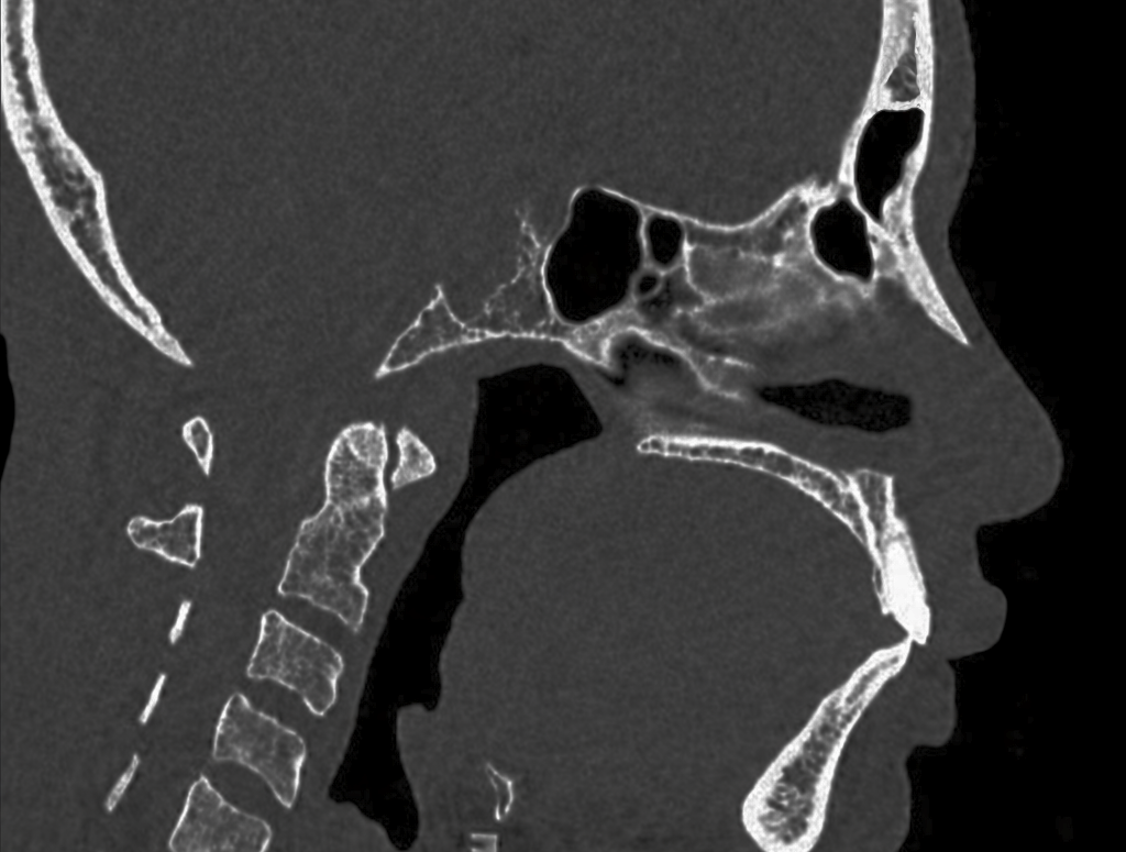 chordoma modified