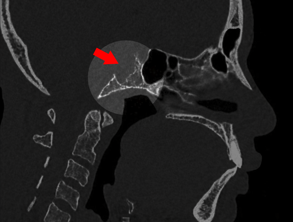 chordoma revealed